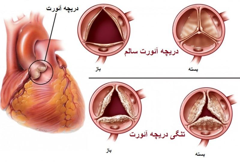 aortic_valve_stenosis.jpg