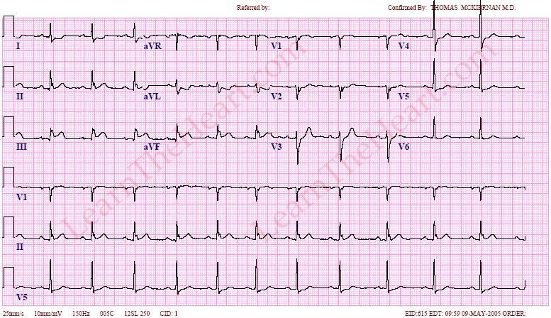 InferiorSTEMI-1.jpg